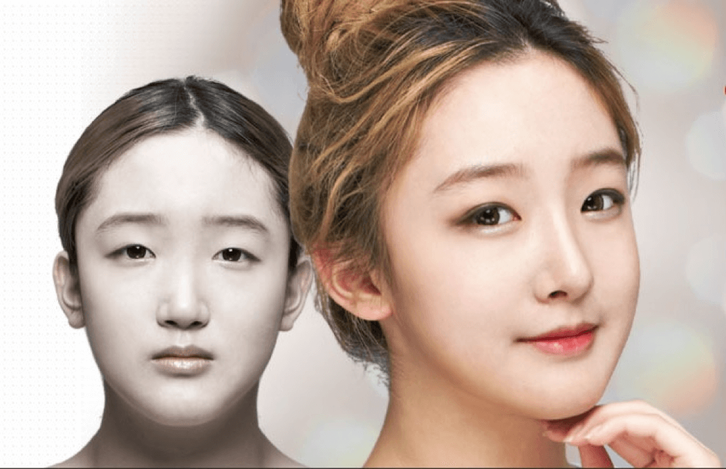 double eyelid plastic surgery