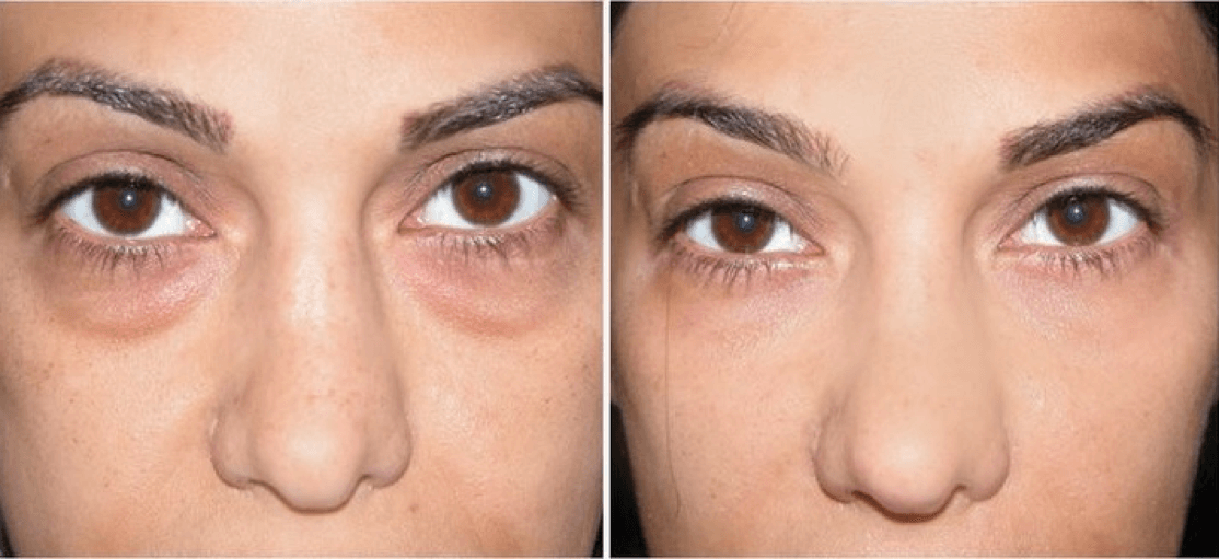 under eye surgery