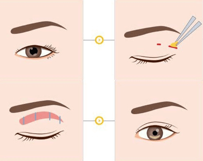 single fold eyelid